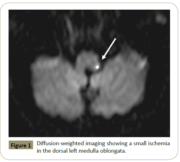 stroke-therapy-Diffusion-weighted